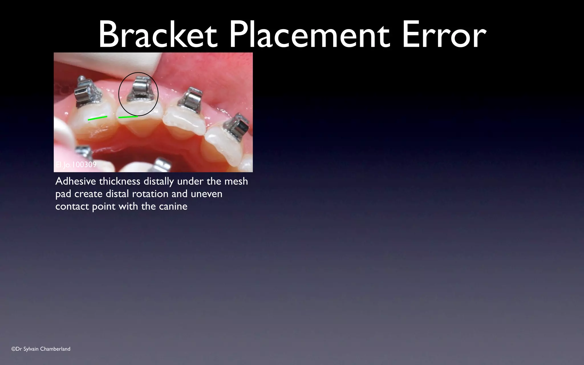 ©Dr Sylvain Chamberland
Bracket Placement Error
El.Jo.100309
Adhesive thickness distally under the mesh
pad create distal rotation and uneven
contact point with the canine
 