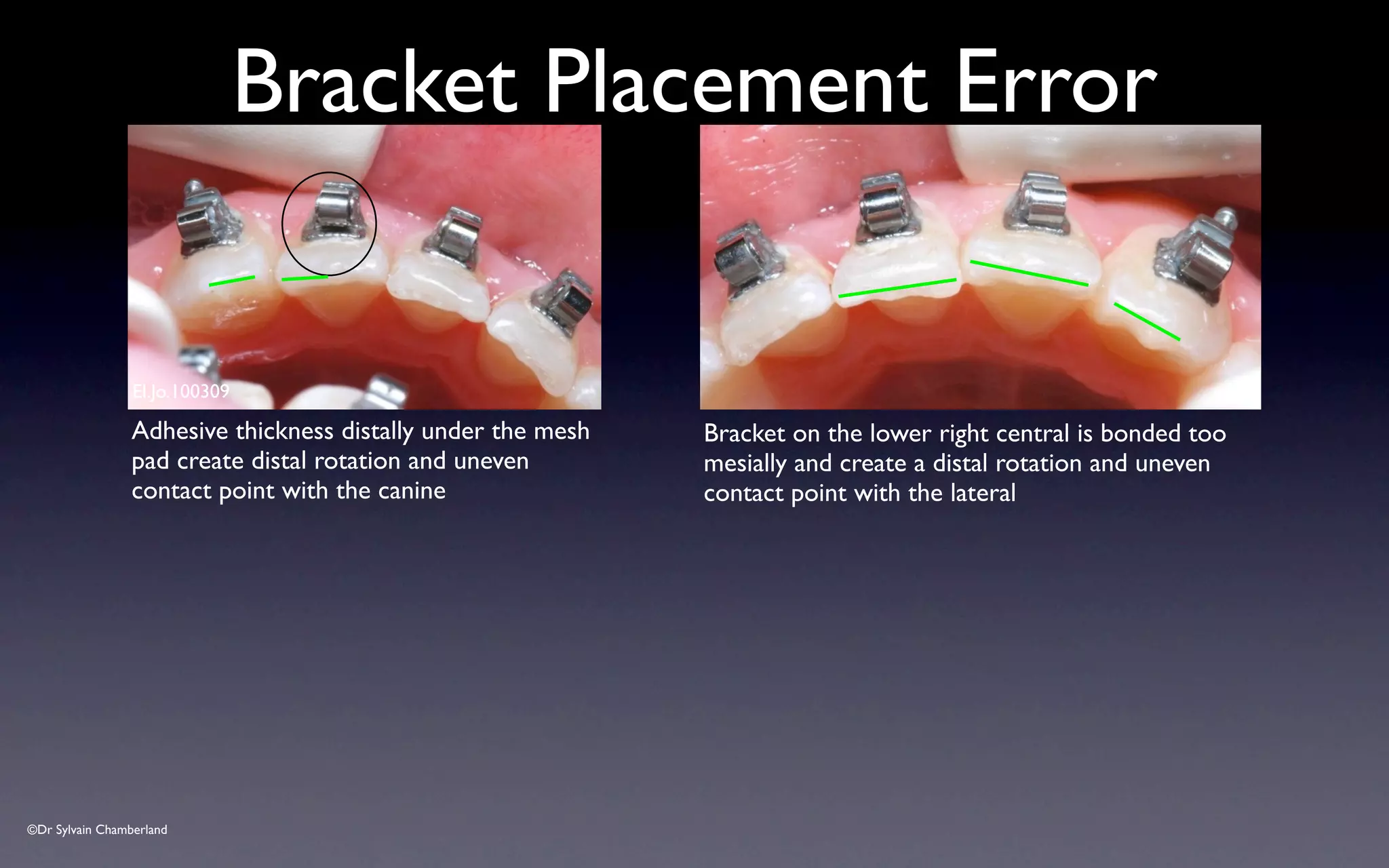 ©Dr Sylvain Chamberland
Bracket Placement Error
El.Jo.100309
Adhesive thickness distally under the mesh
pad create distal rotation and uneven
contact point with the canine
Bracket on the lower right central is bonded too
mesially and create a distal rotation and uneven
contact point with the lateral
 