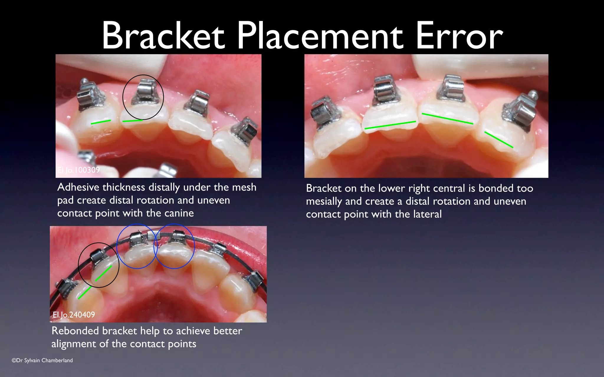 ©Dr Sylvain Chamberland
Bracket Placement Error
El.Jo.100309
Adhesive thickness distally under the mesh
pad create distal rotation and uneven
contact point with the canine
Bracket on the lower right central is bonded too
mesially and create a distal rotation and uneven
contact point with the lateral
El.Jo.240409
Rebonded bracket help to achieve better
alignment of the contact points
 