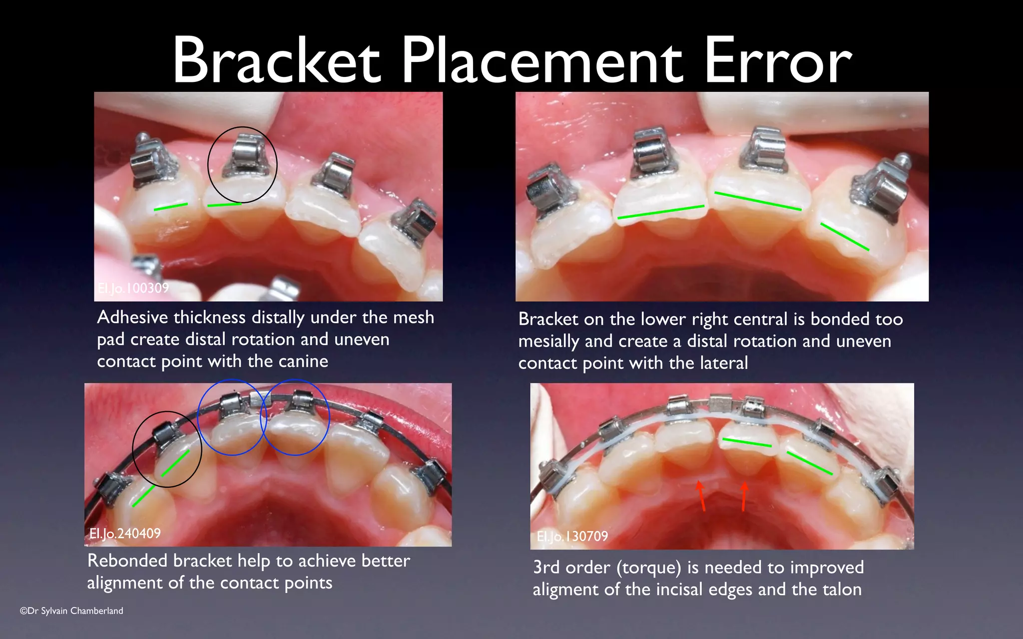©Dr Sylvain Chamberland
Bracket Placement Error
El.Jo.100309
Adhesive thickness distally under the mesh
pad create distal rotation and uneven
contact point with the canine
Bracket on the lower right central is bonded too
mesially and create a distal rotation and uneven
contact point with the lateral
El.Jo.240409
Rebonded bracket help to achieve better
alignment of the contact points
El.Jo.130709
3rd order (torque) is needed to improved
aligment of the incisal edges and the talon
 