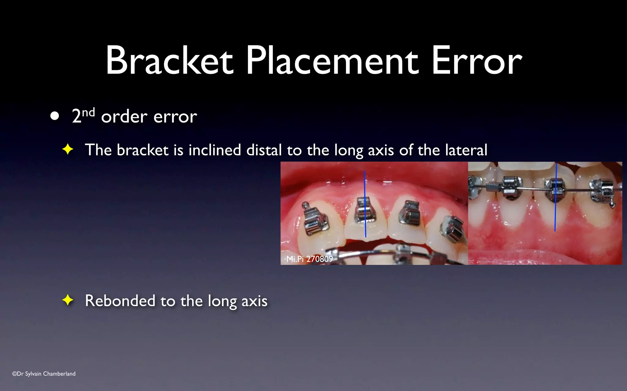 ©Dr Sylvain Chamberland
Bracket Placement Error
• 2nd order error
✦ The bracket is inclined distal to the long axis of the lateral
✦ Rebonded to the long axis
Mi.Pi 270809
 