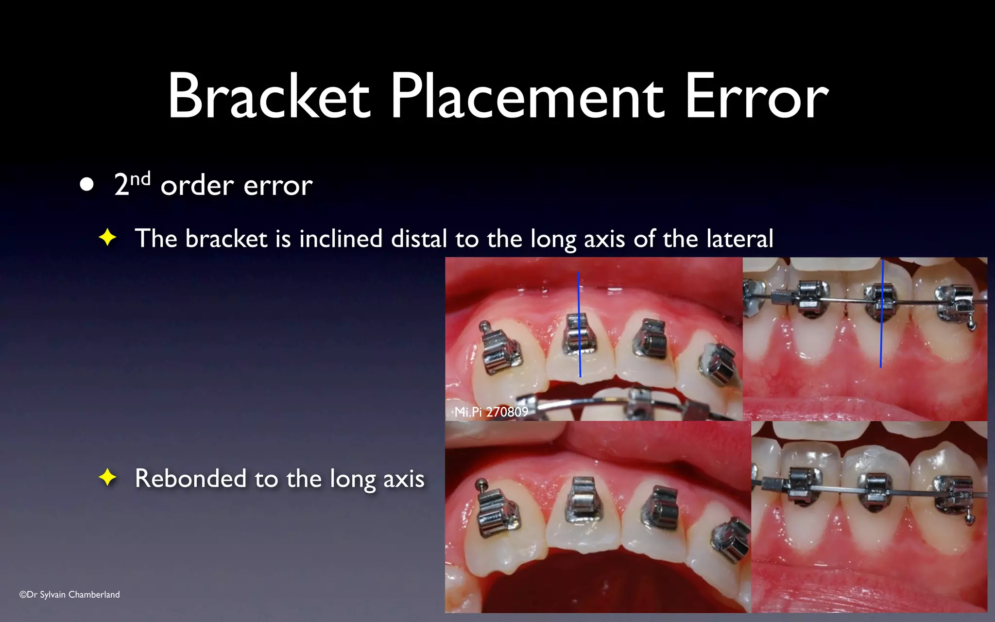 ©Dr Sylvain Chamberland
Bracket Placement Error
• 2nd order error
✦ The bracket is inclined distal to the long axis of the lateral
✦ Rebonded to the long axis
Mi.Pi 270809
 