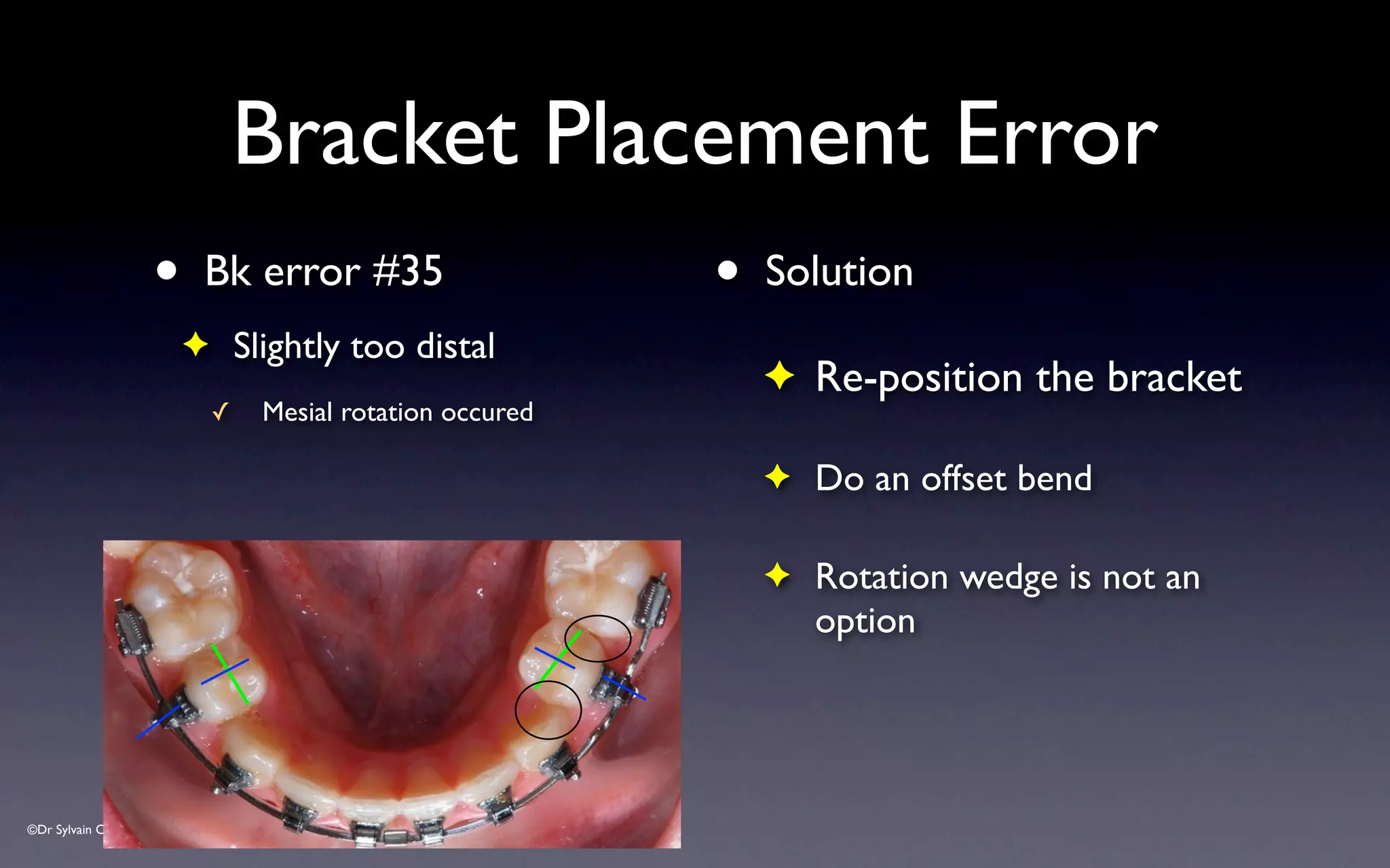 ©Dr Sylvain Chamberland
• Bk error #35
✦ Slightly too distal
✓ Mesial rotation occured
• Solution
✦ Re-position the bracket
✦ Do an offset bend
✦ Rotation wedge is not an
option
Bracket Placement Error
 