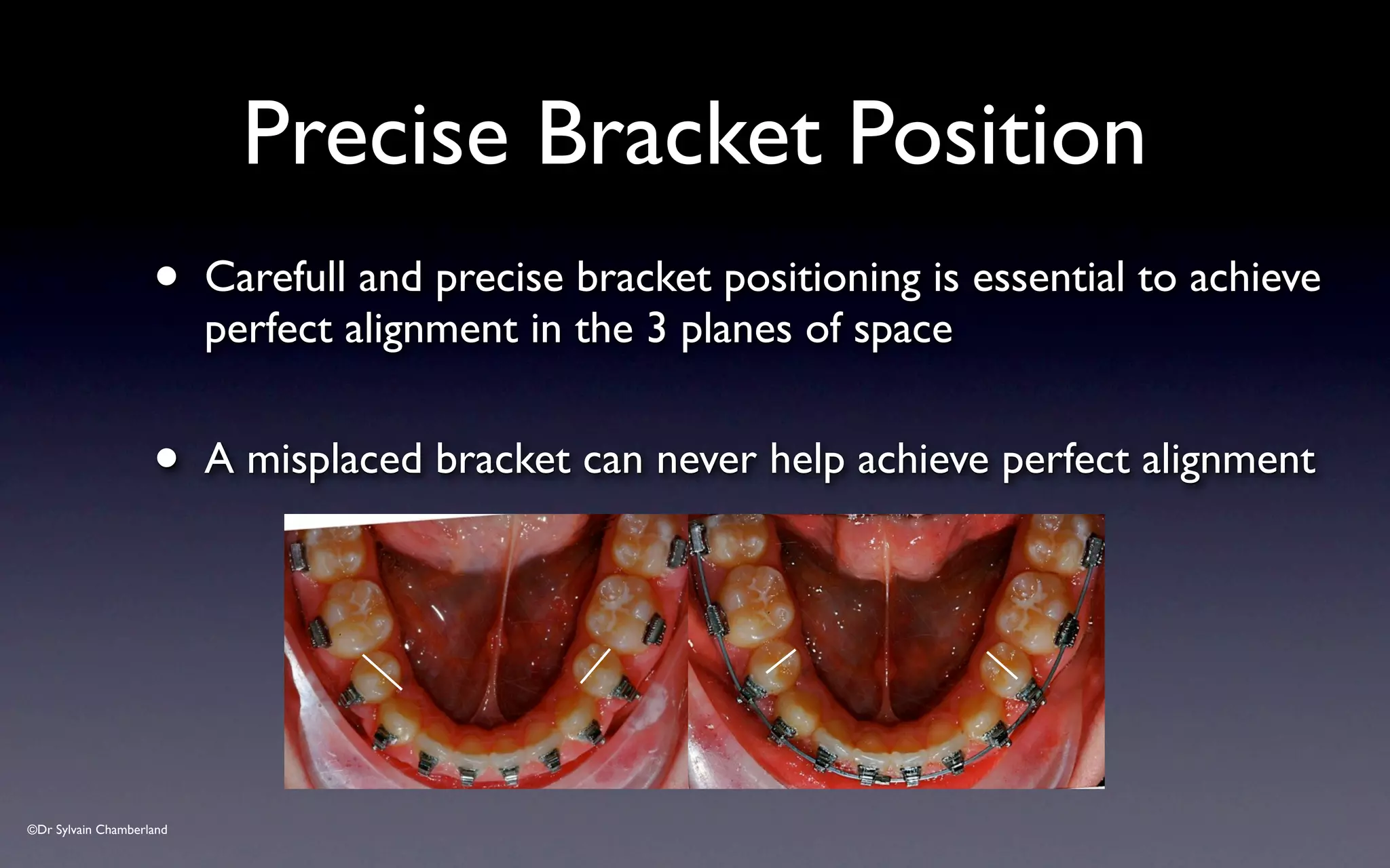 ©Dr Sylvain Chamberland
Precise Bracket Position
• Carefull and precise bracket positioning is essential to achieve
perfect alignment in the 3 planes of space
• A misplaced bracket can never help achieve perfect alignment
 
