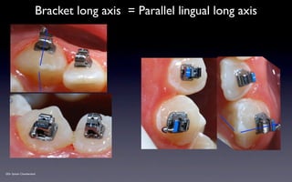 SPEED Bracket Placement Guide v2012 | KEY