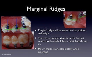 Margial Ridge SPEED Bracket Placement Guide v2012 | KEY