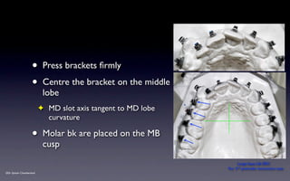 SPEED Bracket Placement Guide v2012 | KEY