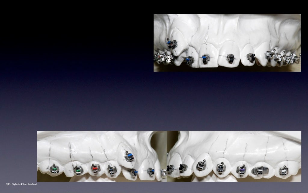 SPEED Bracket Placement Guide v2012