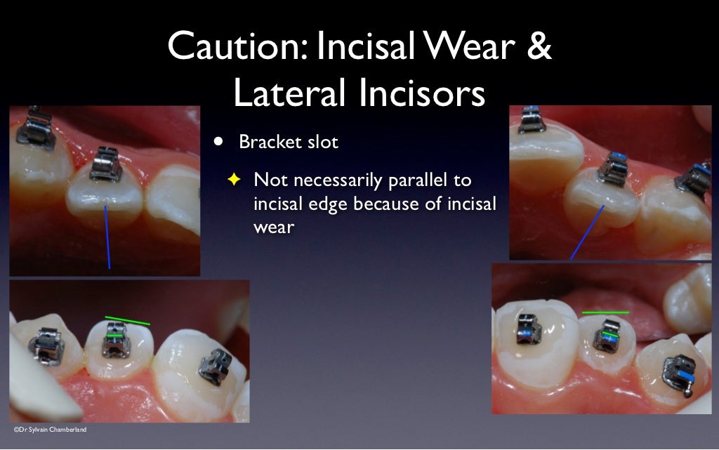 SPEED Bracket Placement Guide v2012