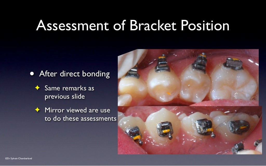 SPEED Bracket Placement Guide v2012