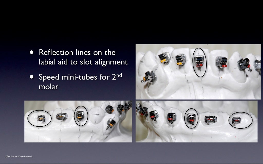 SPEED Bracket Placement Guide v2012