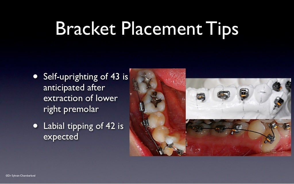 SPEED Bracket Placement Guide v2012