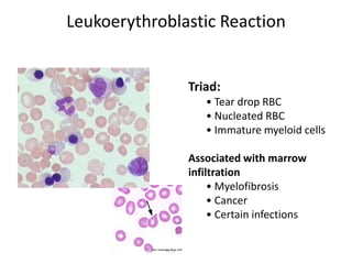 Leukoerythroblastic Reaction


               Triad:
                  • Tear drop RBC
                  • Nucleated RBC
                  • Immature myeloid cells

               Associated with marrow
               infiltration
                    • Myelofibrosis
                    • Cancer
                    • Certain infections
 