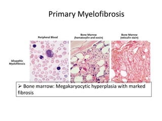 Primary Myelofibrosis




 Bone marrow: Megakaryocytic hyperplasia with marked
fibrosis
 