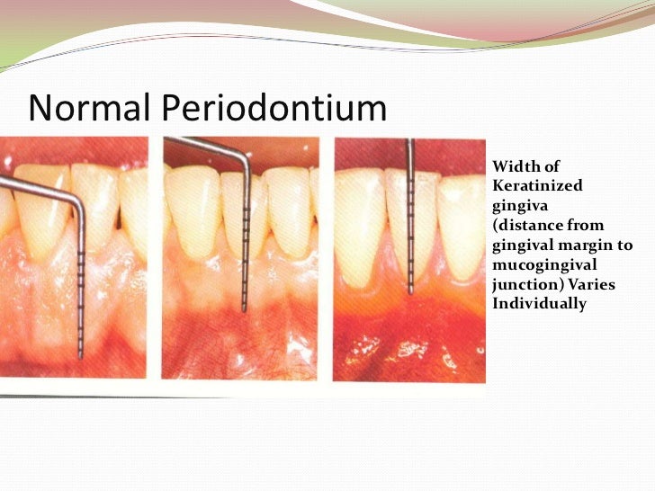 Introduction to Periodontics