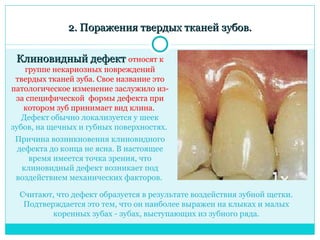 2. Поражения твердых тканей зубов.

 Клиновидный дефект относят к
    группе некариозных повреждений
 твердых тканей зуба. Свое название это
патологическое изменение заслужило из-
 за специфической формы дефекта при
   котором зуб принимает вид клина.
   Дефект обычно локализуется у шеек
зубов, на щечных и губных поверхностях.
 Причина возникновения клиновидного
 дефекта до конца не ясна. В настоящее
    время имеется точка зрения, что
  клиновидный дефект возникает под
 воздействием механических факторов.

  Считают, что дефект образуется в результате воздействия зубной щетки.
   Подтверждается это тем, что он наиболее выражен на клыках и малых
          коренных зубах - зубах, выступающих из зубного ряда.
 