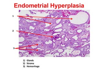 Endometrial Hyperplasia
1




2




3



      1) Glands
      2) Stroma
      3) Hemorrhage
 