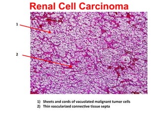 Renal Cell Carcinoma
1




2




     1) Sheets and cords of vacuolated malignant tumor cells
     2) Thin vascularized connective tissue septa
 