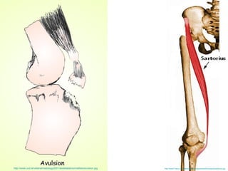 http://www7.tamu-commerce.edu/hpe/sportsmed/trivia/pics/sartorius.jpg   http://www.ucd.ie/vetanat/radiology2001/skeletalabnormalities/avulsion.jpg   