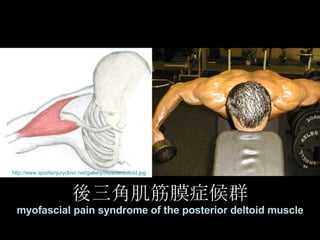 後三角肌筋膜症候群 myofascial pain syndrome of the posterior deltoid muscle http://www.sportsinjuryclinic.net/gallery/muscle/deltoid.jpg   
