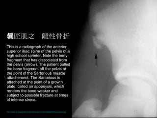 縫匠肌之剝離性骨折 This is a radiograph of the anterior superior illiac spine of the pelvis of a high school sprinter. Note the bony fragment that has dissociated from the pelvis (arrow). The patient pulled the bone fragment off the pelvis at the point of the Sartorious muscle attachement. The Sartorious is attached at the point of a growth plate, called an apopoysis, which renders the bone weaker and subject to possible fracture at times of intense stress.  http://www.vh.org/adult/provider/radiology/icmrad/skeletal/Parts/Avulsion.jpg   