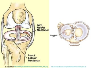 http://www.yoursportsdoc.com/media/men_tear.jpg   http://www.leadingmd.com/patientEd/assets/incomplete_tear.gif   