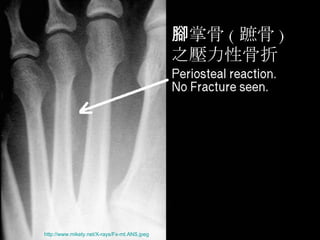 腳掌骨 ( 蹠骨 ) 之壓力性骨折 http://www.mikety.net/X-rays/Fx-mt.ANS.jpeg   