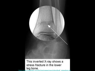 https://www.mylifepath.com/bsc/hw/images/mayo/inline/fsm6_stressfract.jpg   