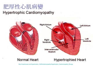 肥厚性心肌病變 http://maxshouse.com/Hypertrophic_%20Cardiomyopathy/Hypertrophic_Cardiomyopathy_Dia.jpg   