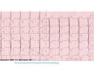 http://www.ekgreading.com/Hypertrophic%20cardiomyopathy.jpg   