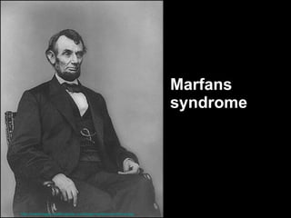 Marfans  syndrome http://medimages.healthopedia.com/large/marfans-syndrome.jpg   