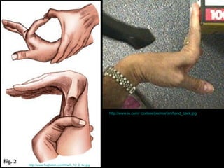 http://www.hughston.com/hha/b_12_2_4c.jpg   http://www.io.com/~cortese/pix/marfan/hand_back.jpg   