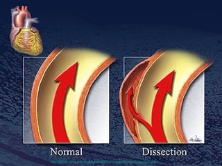 http://www.bcm.edu/findings/vol2/is3/images/aortic-dissection.jpg   