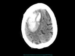 http://www.emedicine.com/neuro/images/687TPA.jpg   