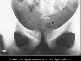 Superior corner of pubic symphysis avulsion in a 16 year old fencer  