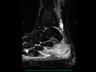 the failure of the skeleton to withstand submaximal forces over time.  the failure of the skeleton to withstand submaximal forces over time.  http://www.mypacs.net/repos/mpv3_repo/viz/full/17093/854689.jpg   