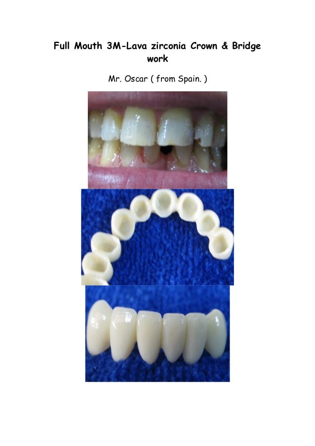 Full Mouth 3MLava zirconia Crown & Bridge work