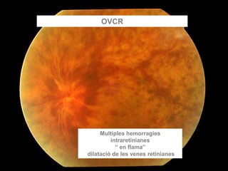 OVCR
Multiples hemorragies
intraretinianes
“ en flama”
dilatació de les venes retinianes
 