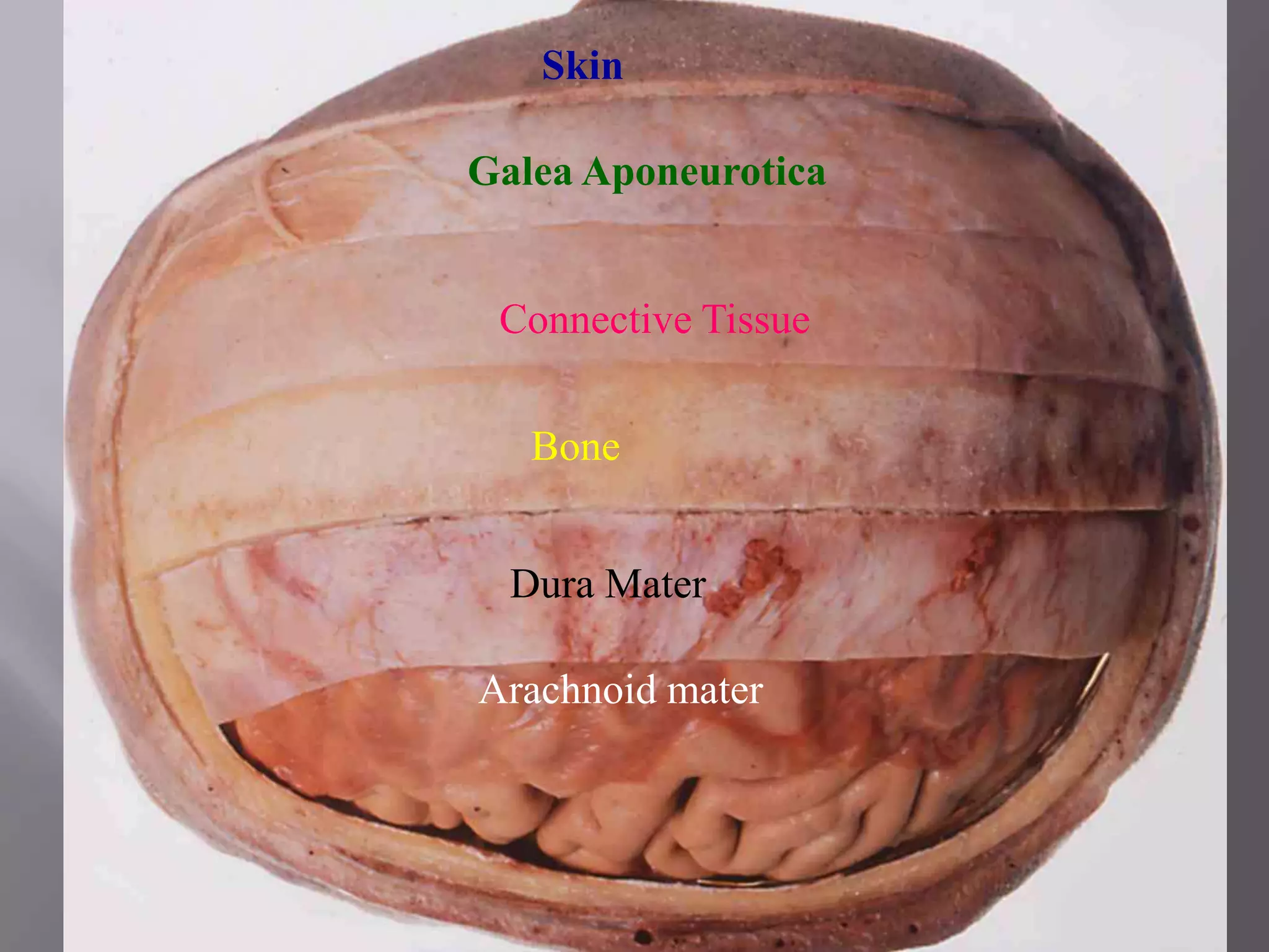 Skin
Galea Aponeurotica

Connective Tissue
Bone
Dura Mater
Arachnoid mater

 