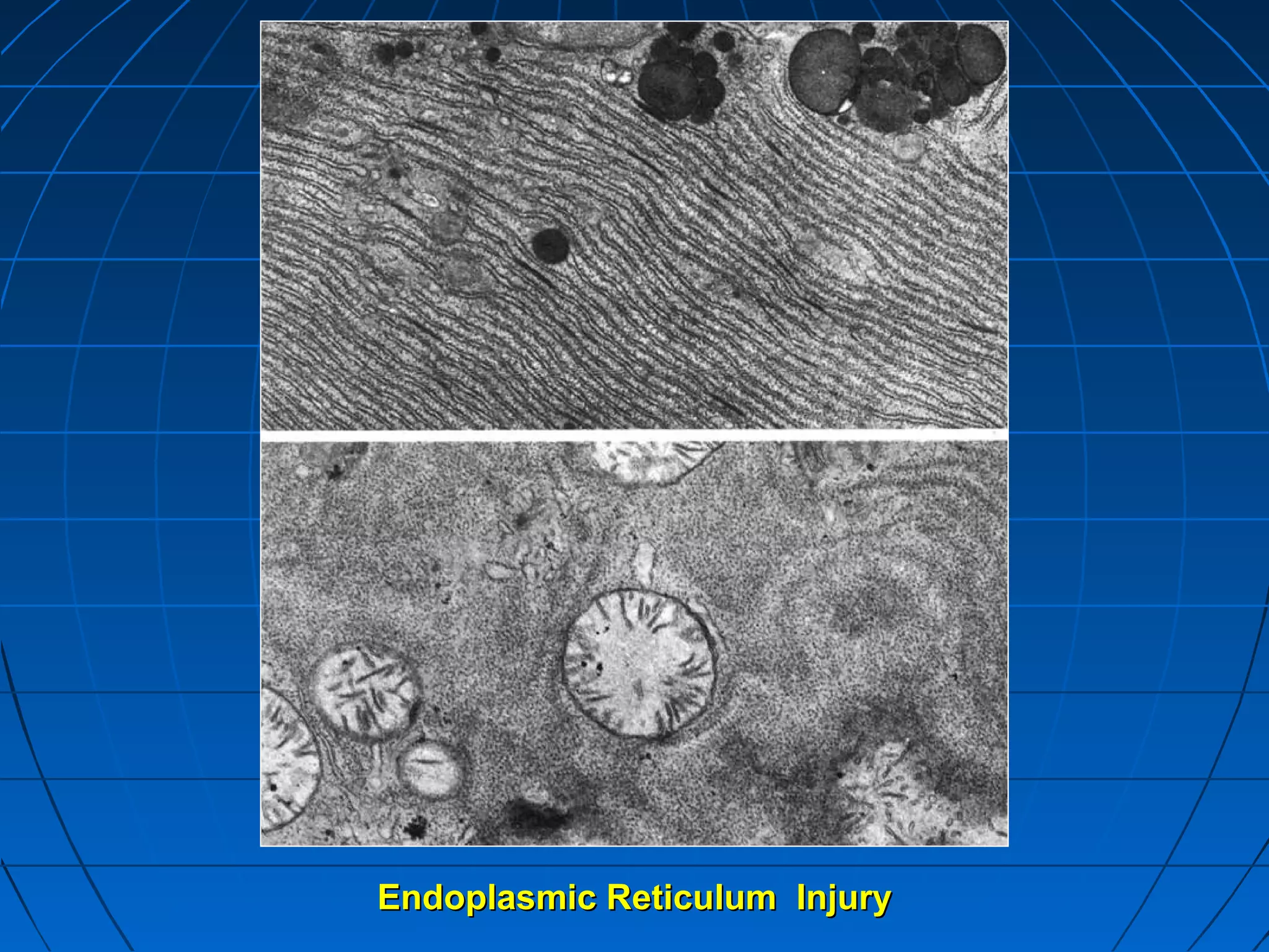 Endoplasmic Reticulum Injury

 