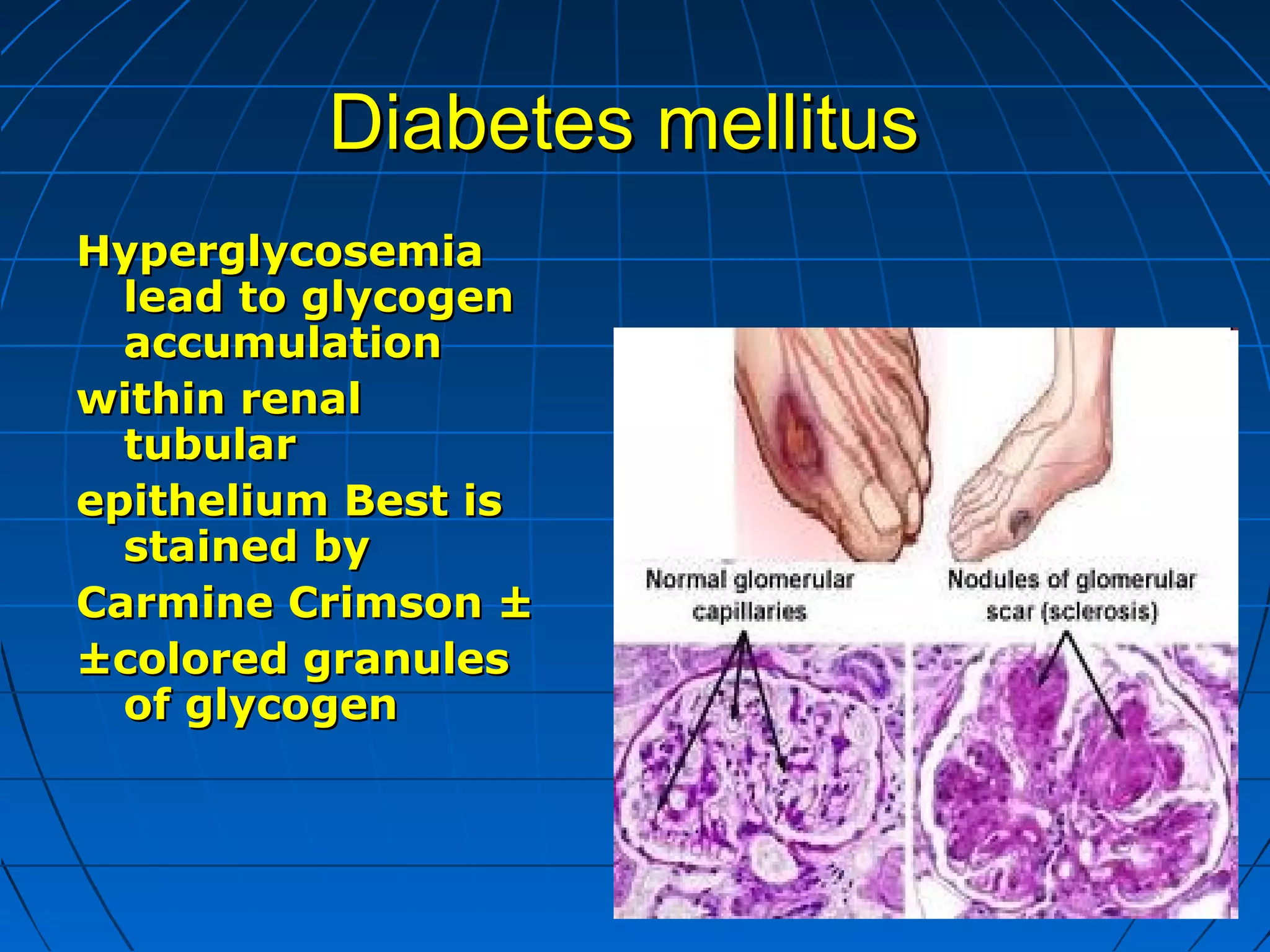 Diabetes mellitus
Hyperglycosemia
lead to glycogen
accumulation
within renal
tubular
epithelium Best is
stained by
Carmine Crimson ±
±colored granules
of glycogen

 