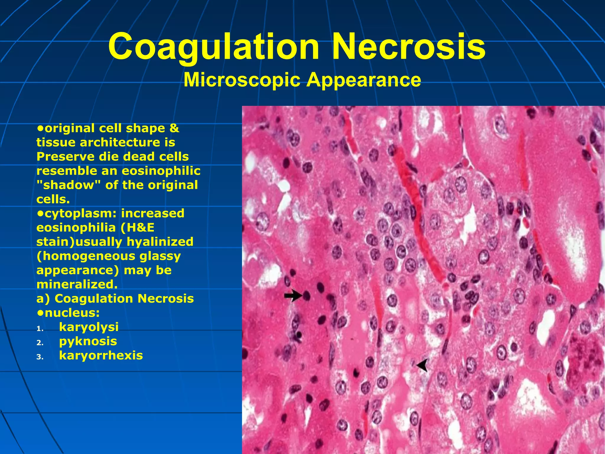 Coagulation Necrosis
Microscopic Appearance
•original cell shape &
tissue architecture is
Preserve die dead cells
resemble an eosinophilic
"shadow" of the original
cells.
•cytoplasm: increased
eosinophilia (H&E
stain)usually hyalinized
(homogeneous glassy
appearance) may be
mineralized.
a) Coagulation Necrosis
•nucleus:
1.
karyolysi
2.
pyknosis
3.
karyorrhexis

 