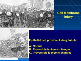 Cell Membrane
Injury

Epithelial cell proximal kidney tubule
A. Normal
B. Reversible ischemic changes
C. Irreversible ischemic changes

 