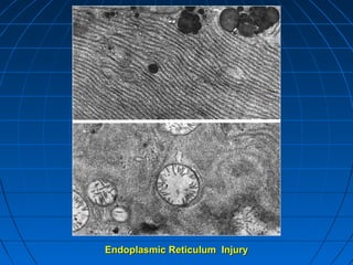 Endoplasmic Reticulum Injury

 