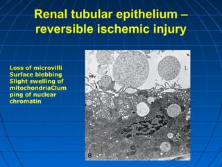 Renal tubular epithelium –
reversible ischemic injury
Loss of microvilli
Surface blebbing
Slight swelling of
mitochondriaClum
ping of nuclear
chromatin

 