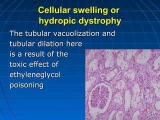 Cellular swelling or
hydropic dystrophy
The tubular vacuolization and
tubular dilation here
is a result of the
toxic effect of
ethyleneglycol
poisoning

 