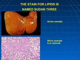 THE STAIN FOR LIPIDS IS
NAMED SUDAN THREE

Gross sample

Micro sample
h/e stained

 