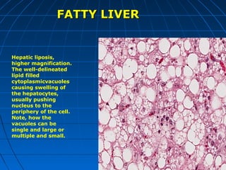 FATTY LIVER

Hepatic liposis,
higher magnification.
The well-delineated
lipid filled
cytoplasmicvacuoles
causing swelling of
the hepatocytes,
usually pushing
nucleus to the
periphery of the cell.
Note, how the
vacuoles can be
single and large or
multiple and small.

 