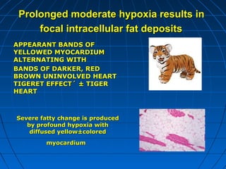 Prolonged moderate hypoxia results in
focal intracellular fat deposits
APPEARANT BANDS OF
YELLOWED MYOCARDIUM
ALTERNATING WITH
BANDS OF DARKER, RED
BROWN UNINVOLVED HEART
TIGERET EFFECT´ ± TIGER
HEART

Severe fatty change is produced
by profound hypoxia with
diffused yellow±colored
myocardium

 