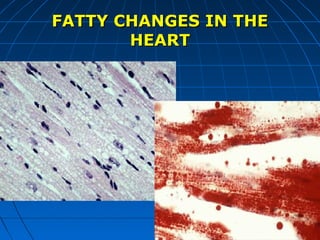 FATTY CHANGES IN THE
HEART

 